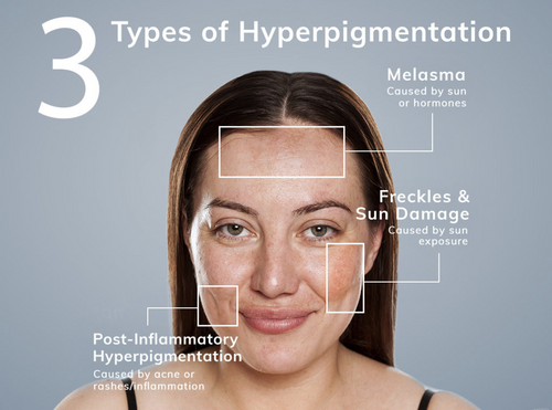 Hyperpigmentation Solutions