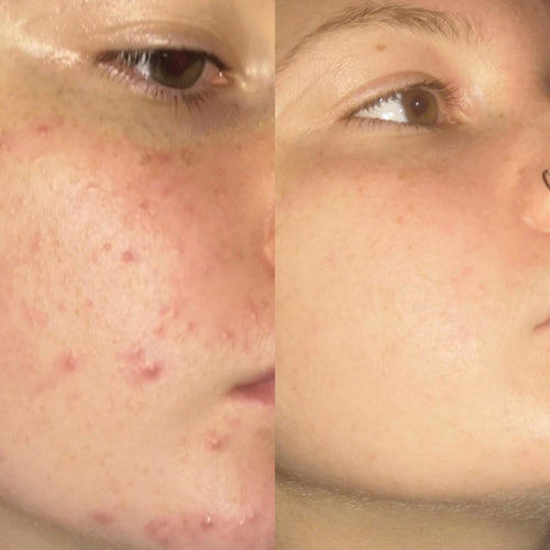 Acne Routine