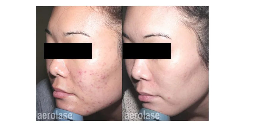 NeoClear Acne Treatment