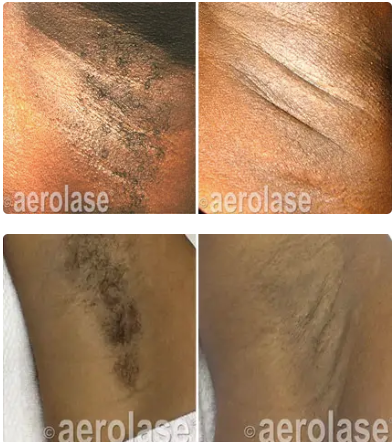 Neo Elite Laser Hair Removal