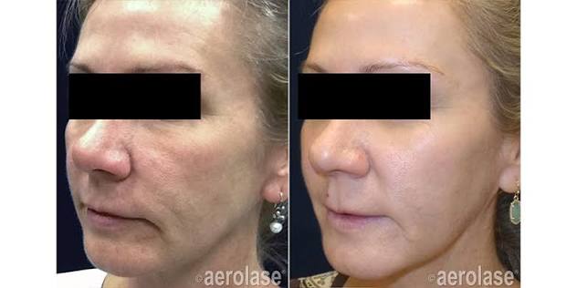 NeoSkin Rejuvenation & Tightening